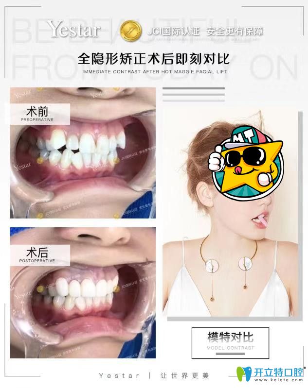 艺星口腔时代天使隐形矫正不齐牙齿<span style= 艺星口腔时代天使隐形矫正不齐牙齿<span style=