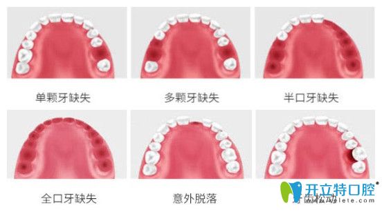 哪些牙齿缺失可以做种植牙图示