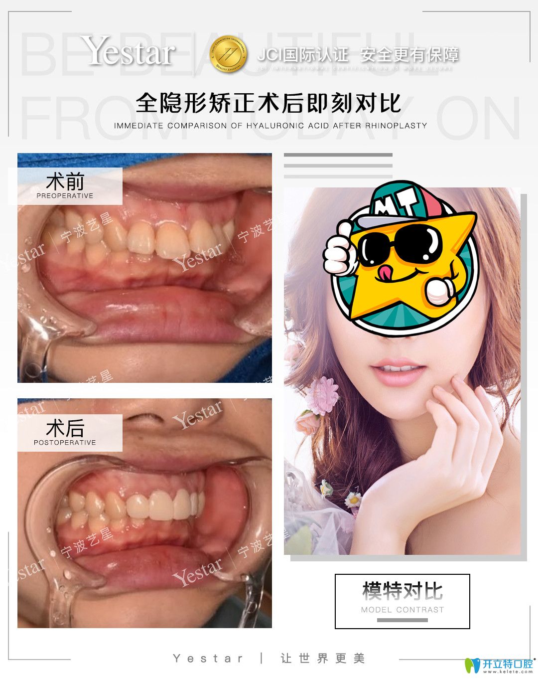 艺星口腔门牙外翻采用隐适美矫正的<span style= 艺星口腔门牙外翻采用隐适美矫正的<span style=