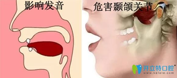 牙齿缺失影响发音及颞颌关节