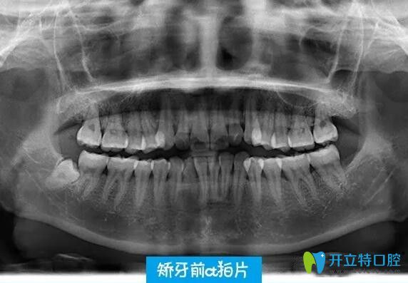 在深圳韦博口腔做牙齿矫拍CT片