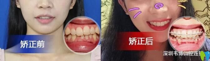门牙前突小姐姐矫正后完成颜值逆袭 门牙前突小姐姐矫正后完成颜值逆袭