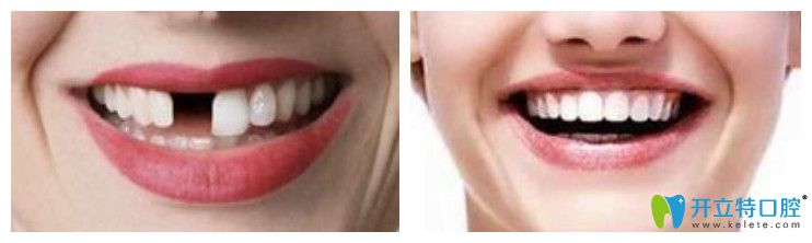 美奥口腔单颗牙种植案例图