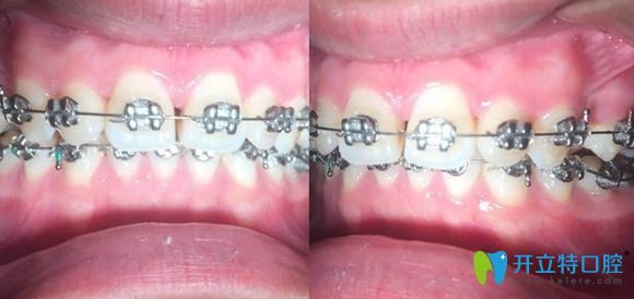 戴金属托槽牙套矫正牙齿的初次复诊照