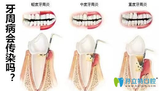 牙周病会传染给别人吗?医生说只要注意这4件事就远离牙周炎