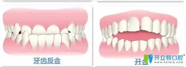 牙齿地包天和开合图示