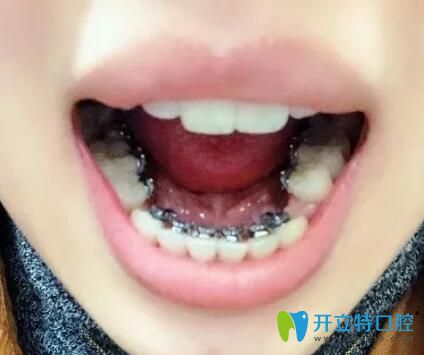 在广州德系口腔做舌侧矫正8个月