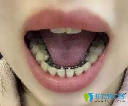 在广州德系口腔做舌侧隐形矫正12个月