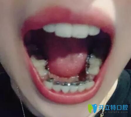 在广州德系口腔做舌侧矫正3个月