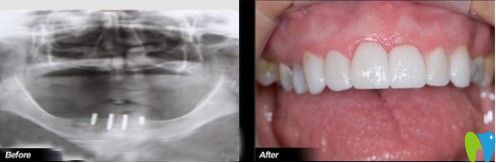 何先生做过种植牙的案列图