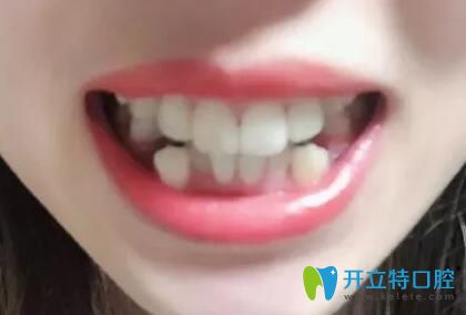 牙齿拥挤在广州德系口腔做矫正前的照片