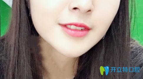 我在珠海九龙口腔做的隐形矫正价格是2万元起 我在珠海九龙口腔做的隐形矫正价格是2万元起