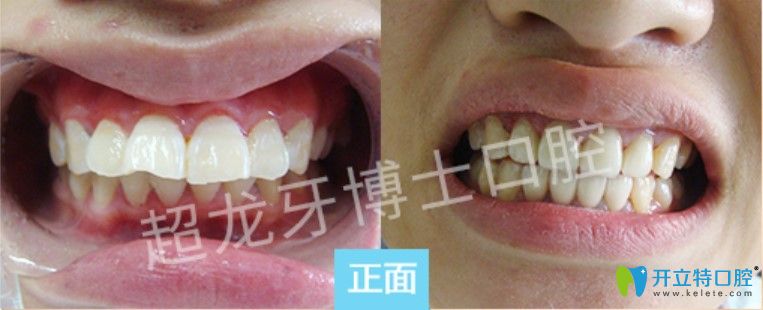 牙博士口腔龅牙矫正案例图