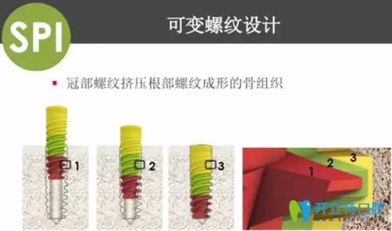 以色列abt种植体早期骨结合良好