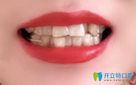 长春超龙牙博士口腔牙齿矫正案例:来自30岁美女的整牙日记