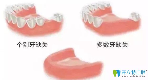 牙齿缺失情况图示