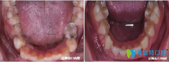 我儿子下牙颌内矫正前后的效果