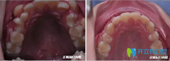 孩子牙齿矫正前后的上牙口内对比图