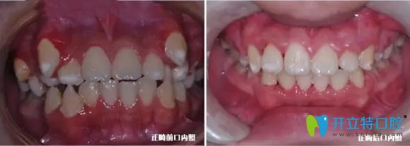 杭州美奥口腔给儿童做的牙齿矫正前后效果