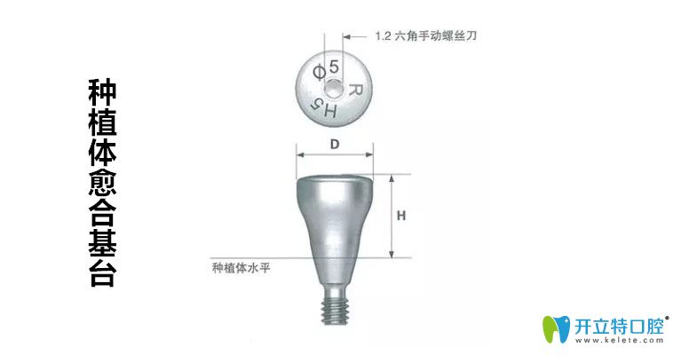 种牙前建议先弄清楚种植牙愈合基台是什么以及它的作用