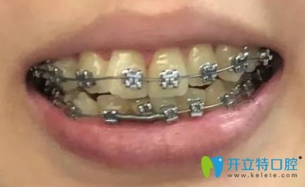牙齿矫正3个月时的效果 牙齿矫正3个月时的效果