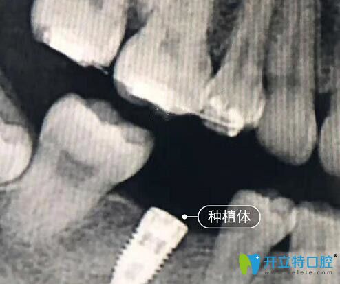 在深圳诺德口腔做种植牙后CT片