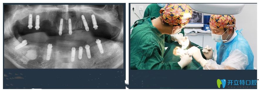 广大口腔全口种植牙手术过程及术后效果
