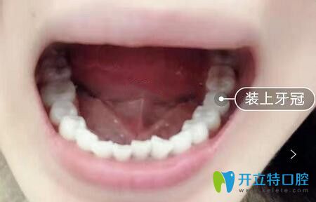 我在深圳诺德口腔做瑞士ITI种植牙后效果