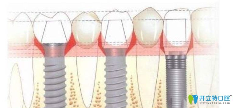 种植牙愈合基台有什么作用