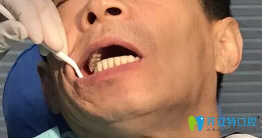 他38岁在武汉清华阳光口腔汉阳总院做了ALL-ON-4全口种植牙