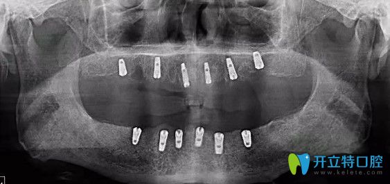 昆明雅度口腔种植牙术后CT