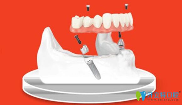  新乡拜博口腔2颗种植体就可修复半口牙