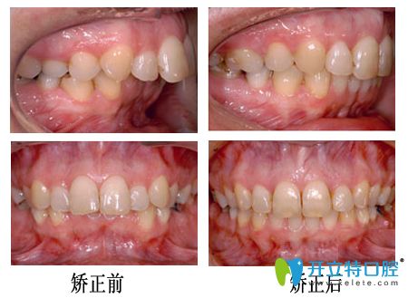 重庆牙博士口腔龅牙矫正案例