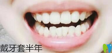 我在深圳诺德口腔做牙齿矫正6个月
