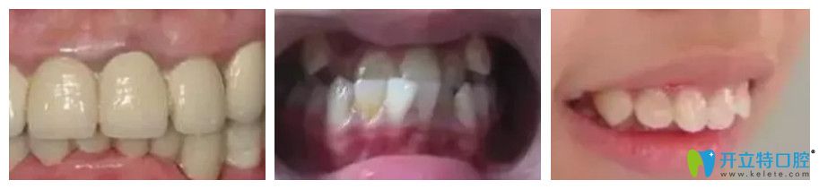 舔牙会导致牙齿深覆盖+地包天+龅牙