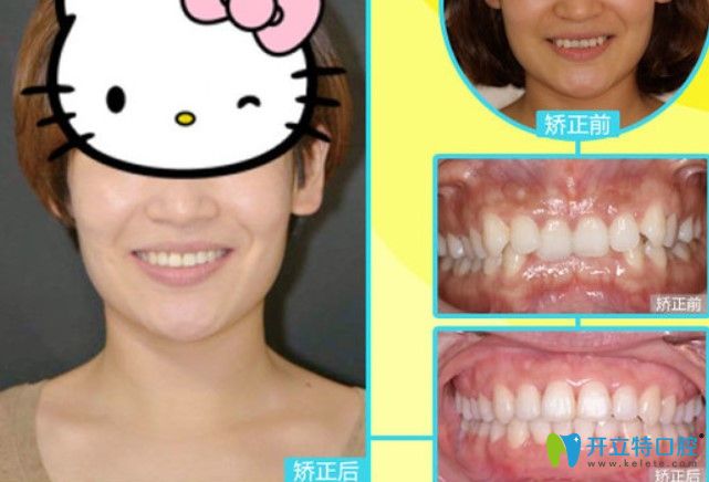 长沙中诺口腔深覆合+牙齿拥挤矫正案例