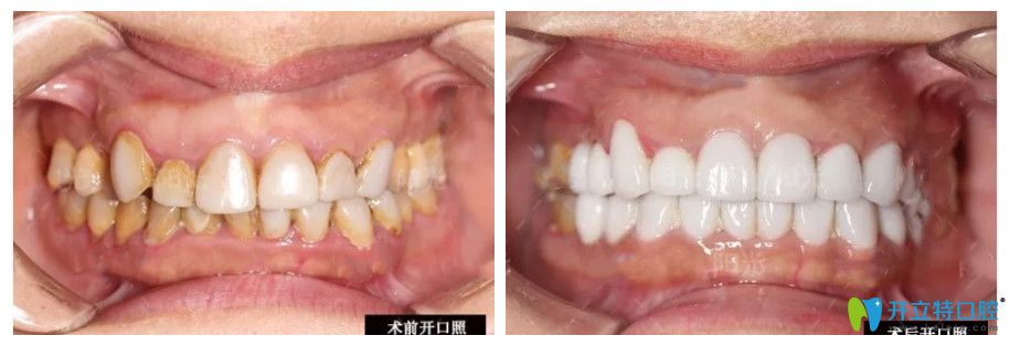 树脂贴面换成瓷贴面修复 树脂贴面换成瓷贴面修复