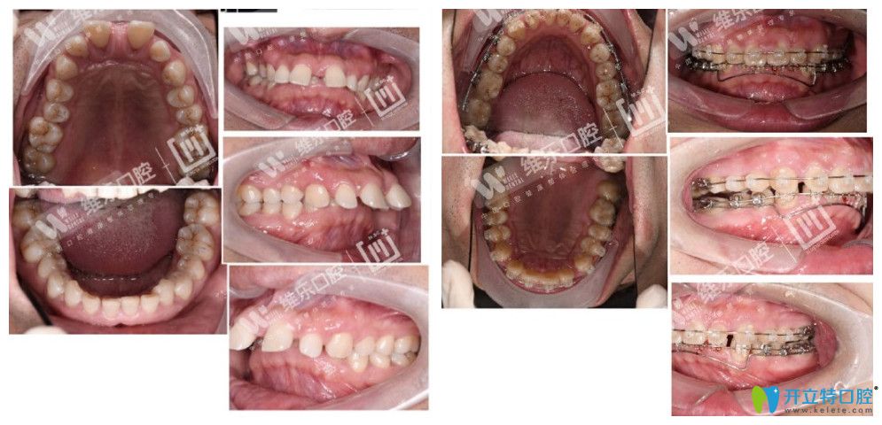 北京维乐口腔不知道去北京哪里做牙齿矫正不妨看下维乐口腔谭晖的案例