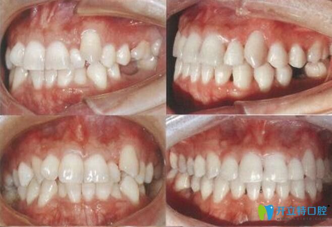 在重庆团圆口腔做的时代天使隐形矫正前后对比图
