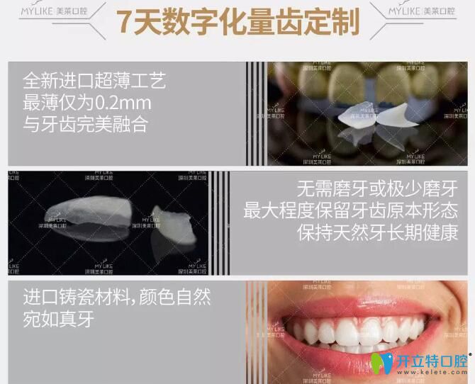 深圳美莱口腔隐形臻薄牙贴面的优势 深圳美莱口腔隐形臻薄牙贴面的优势