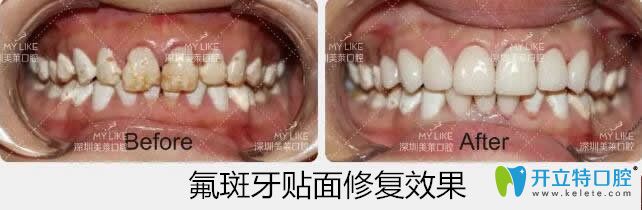 美莱口腔氟斑牙贴面修复案例 美莱口腔氟斑牙贴面修复案例