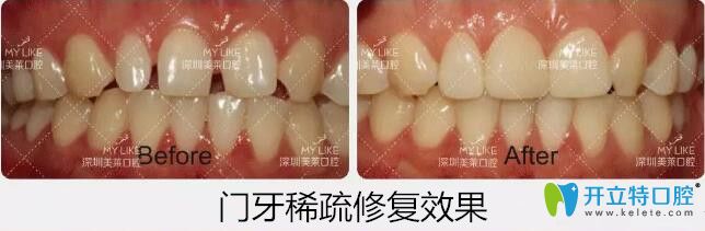 深圳美莱口腔牙齿稀疏贴面案例 深圳美莱口腔牙齿稀疏贴面案例