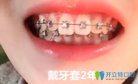 我在青岛优贝口腔做牙齿矫正2年