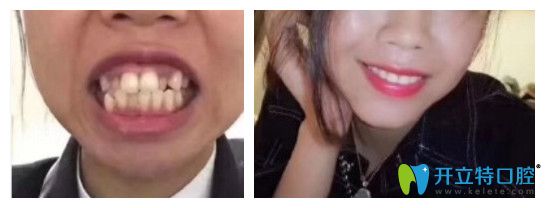 龅牙，牙齿拥挤不齐矫正前后对比图