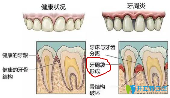 什么是牙周袋 