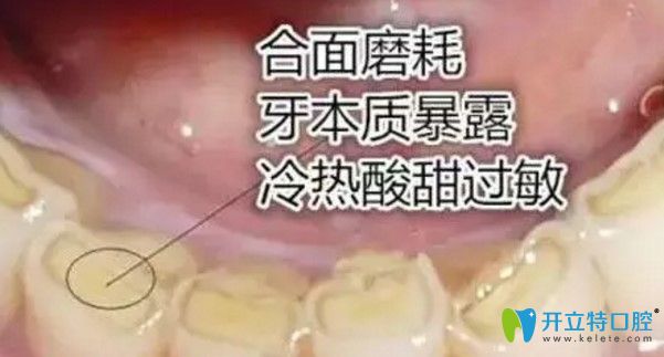 王迪医生告诉大家：长期用单侧牙齿咀嚼食物有什么危害