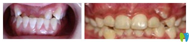 儿童常见的牙齿畸形图