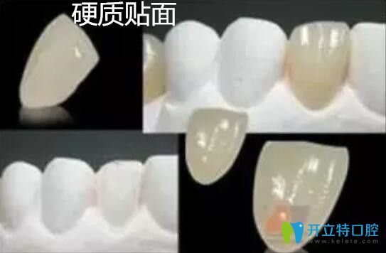 硬质贴面 硬质贴面