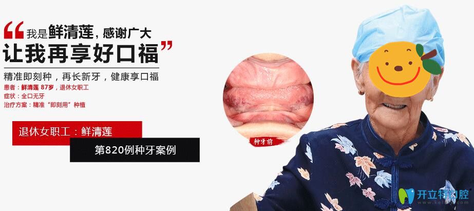 广大口腔为87岁拉破人做精准即可种植牙案例效果图 广大口腔为87岁拉破人做精准即可种植牙案例效果图