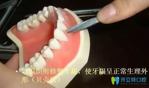 牙龈整形术可使牙龈恢复正常生理外形